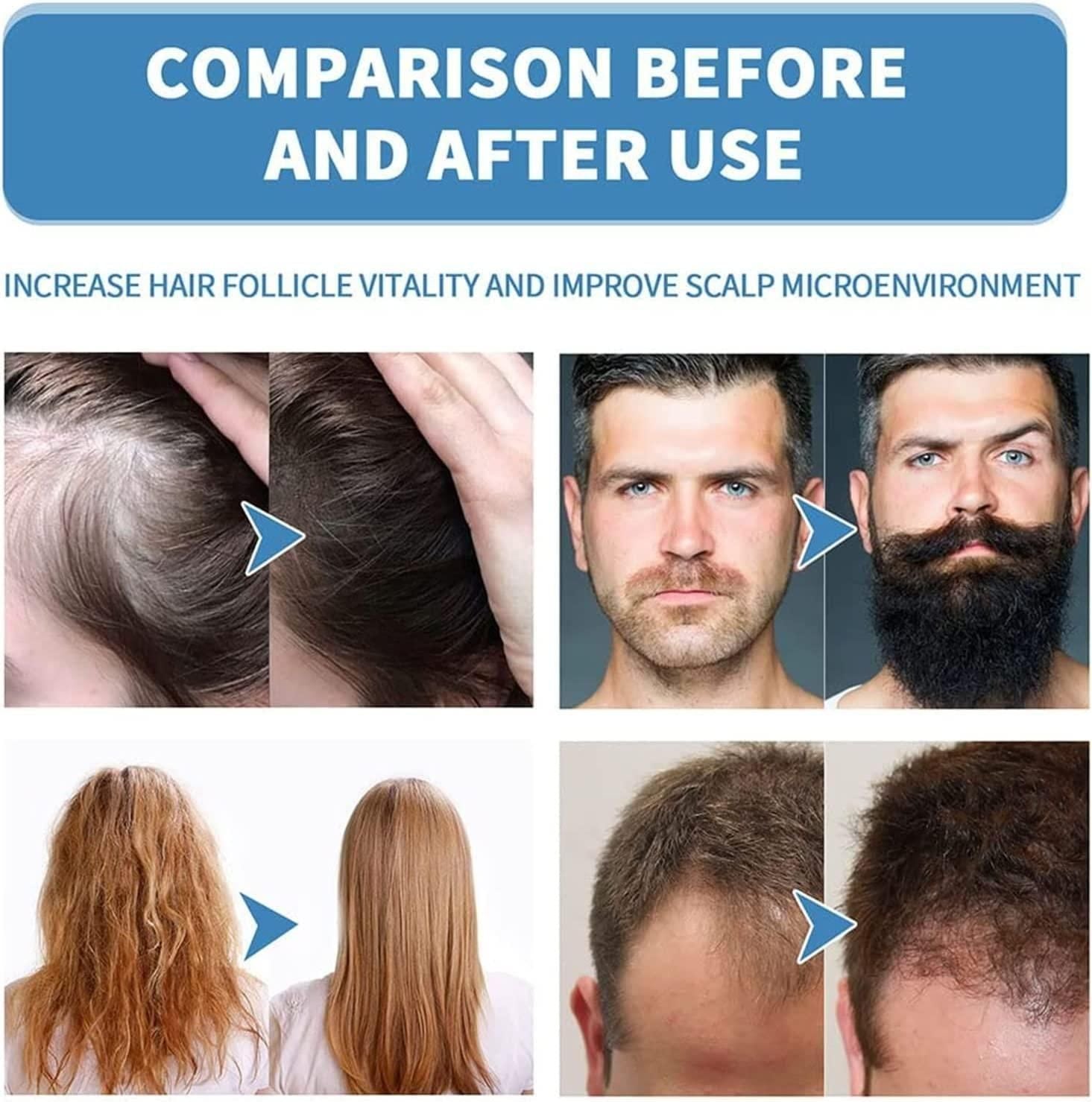 Minoxi Roll-On Hair Growth Serum (Buy 1 Get 1 Free)